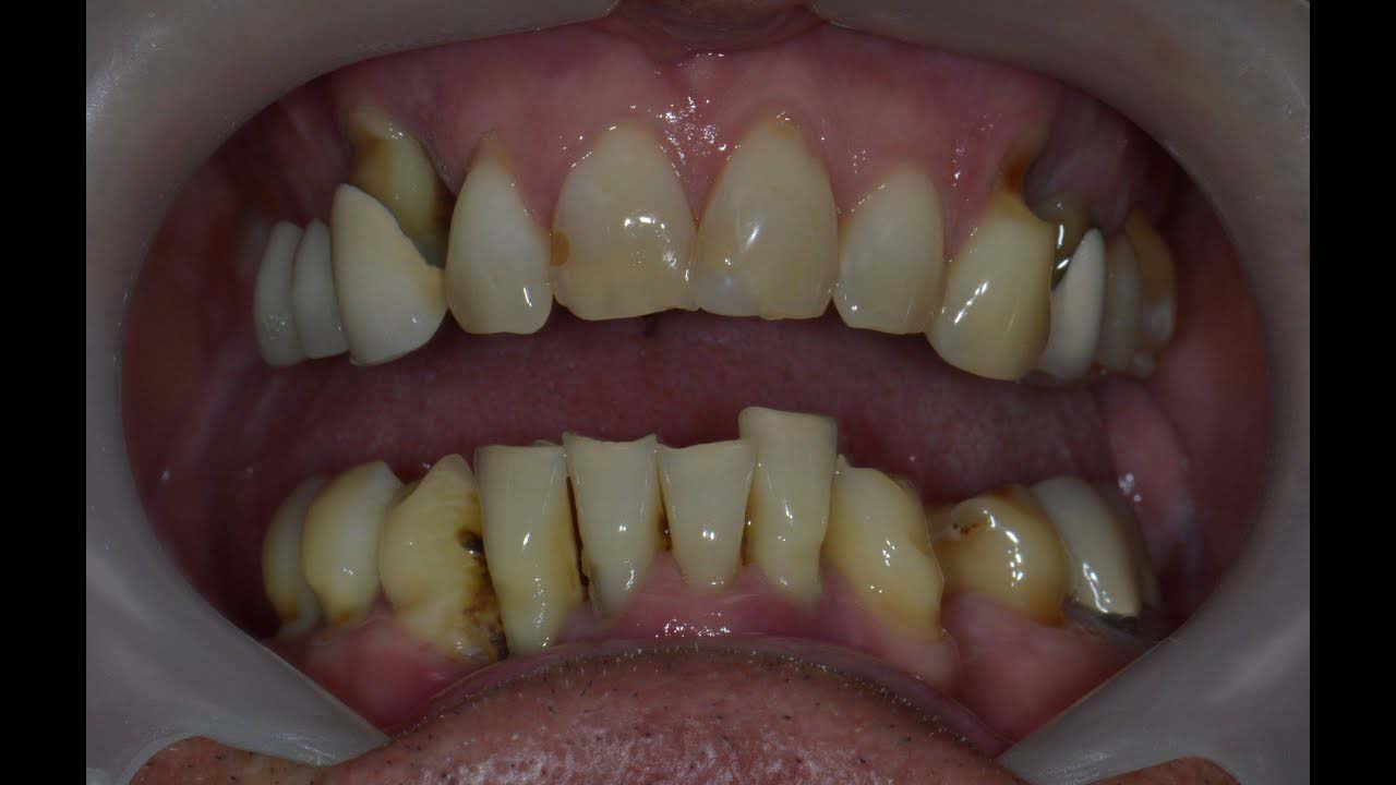 implant teeth