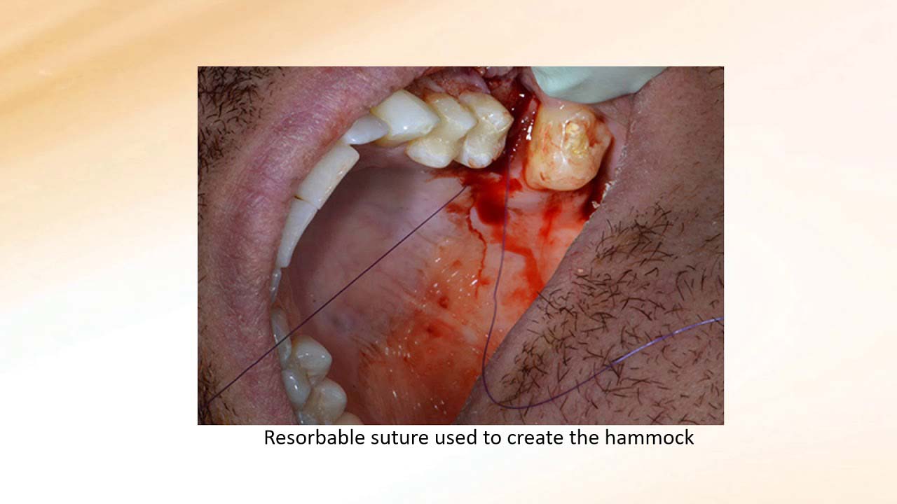 Resorbable suture used to create the hammock