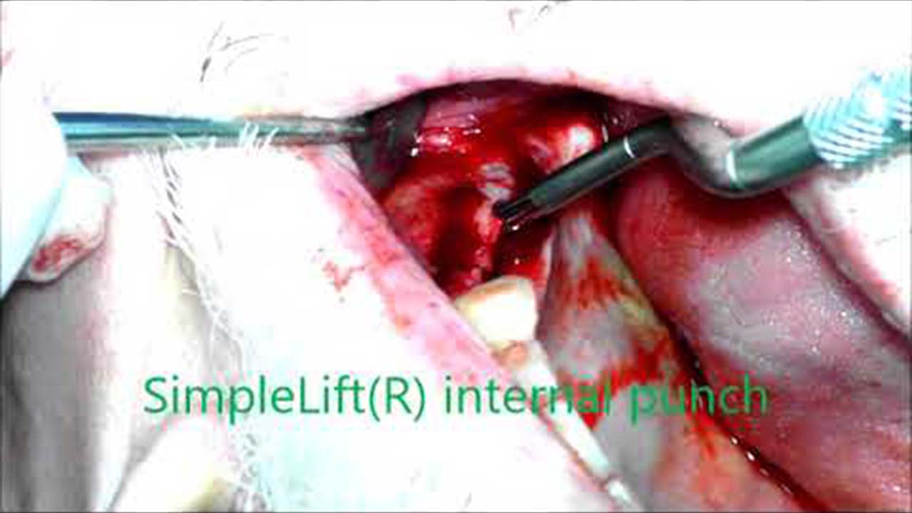 SimpleLift(R) internal punch